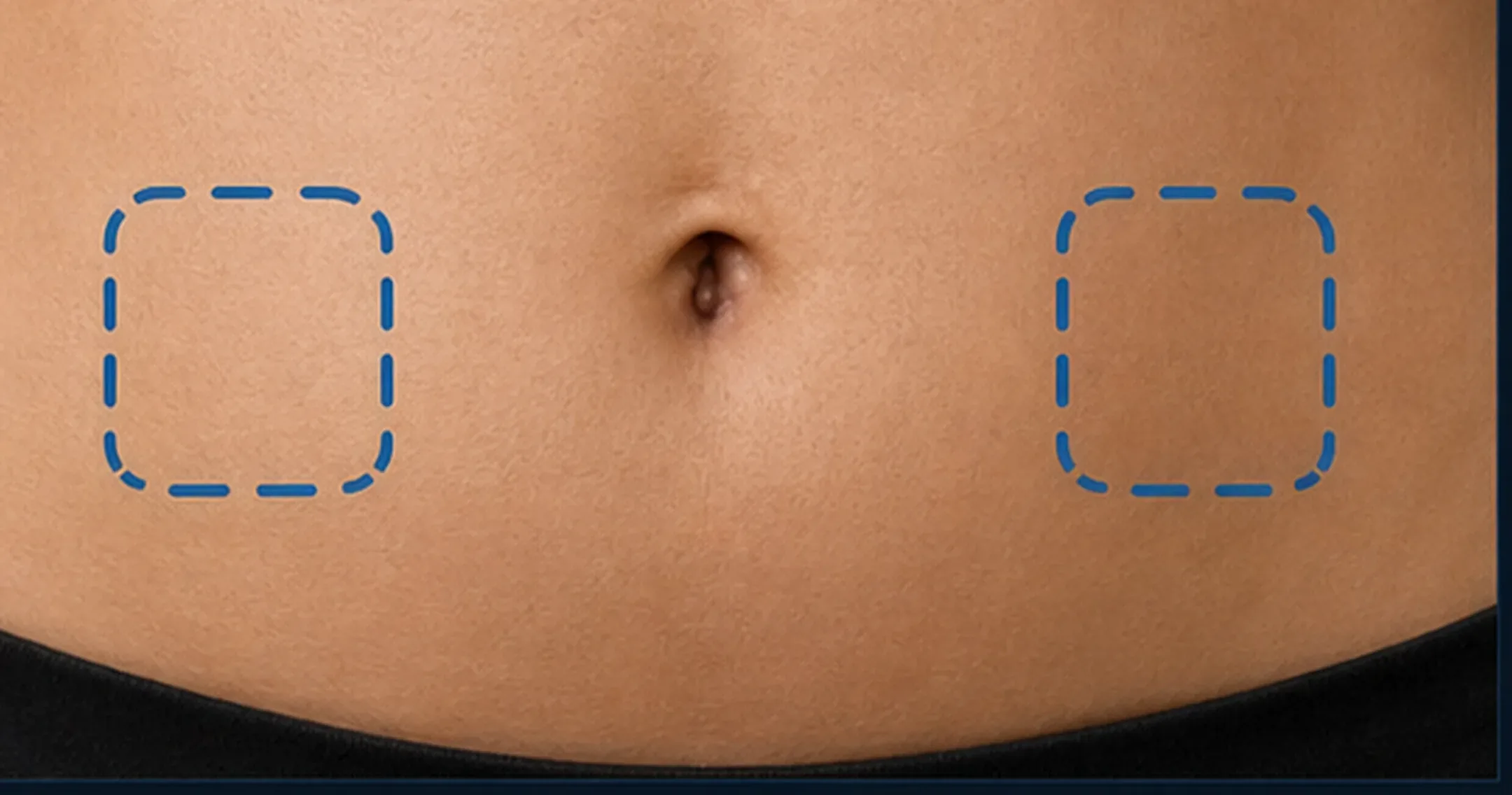 Abdomen con zonas laterales marcadas como puntos de referencia para técnica subcutánea